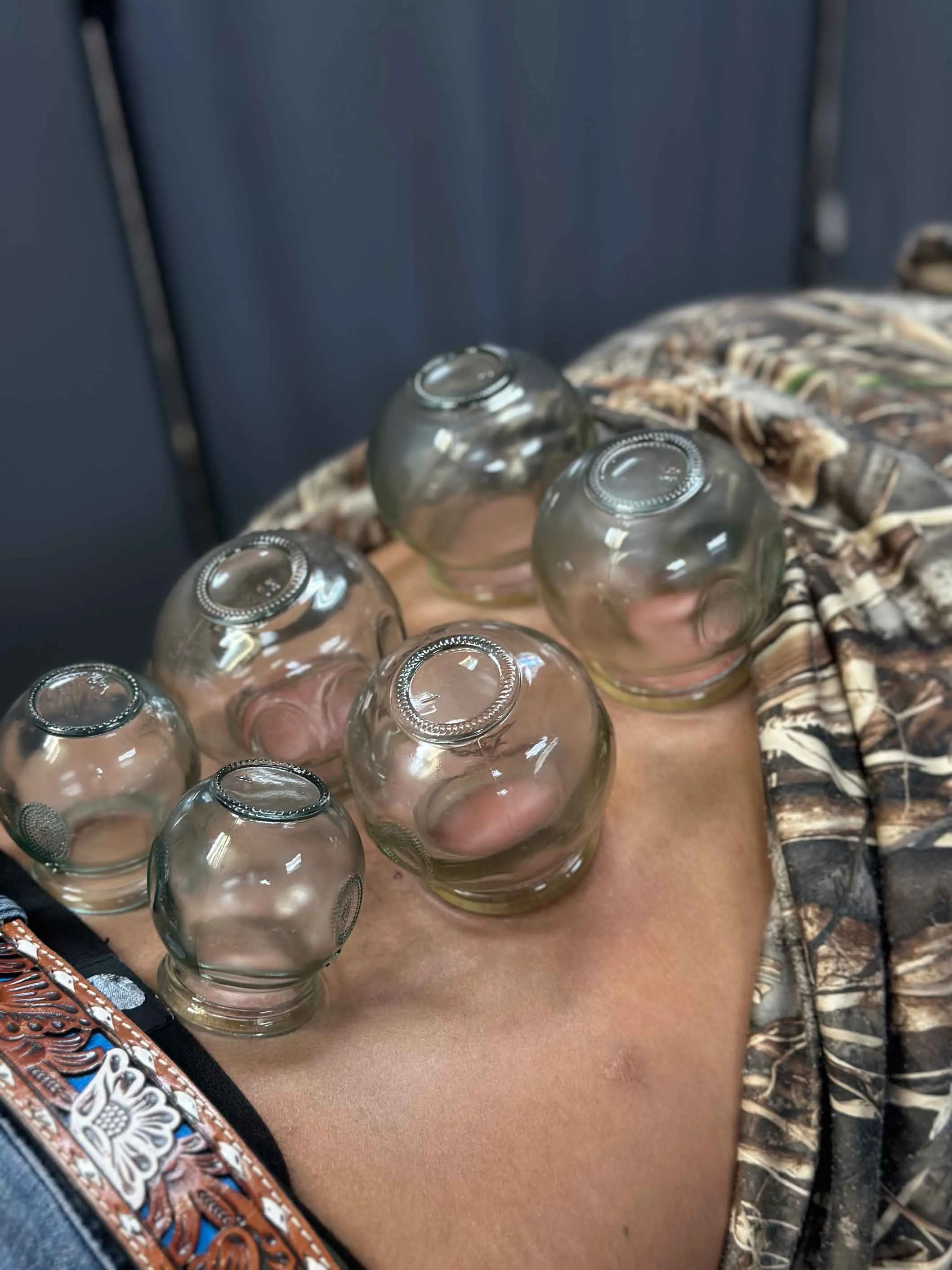 Fire Cupping